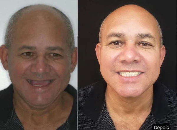 Seu Carlos, antes e depois do implante