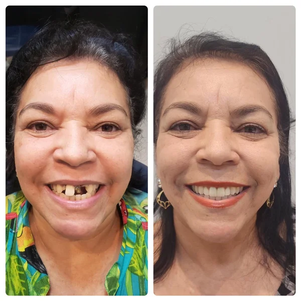 Dona Neide, antes e depois do implante
