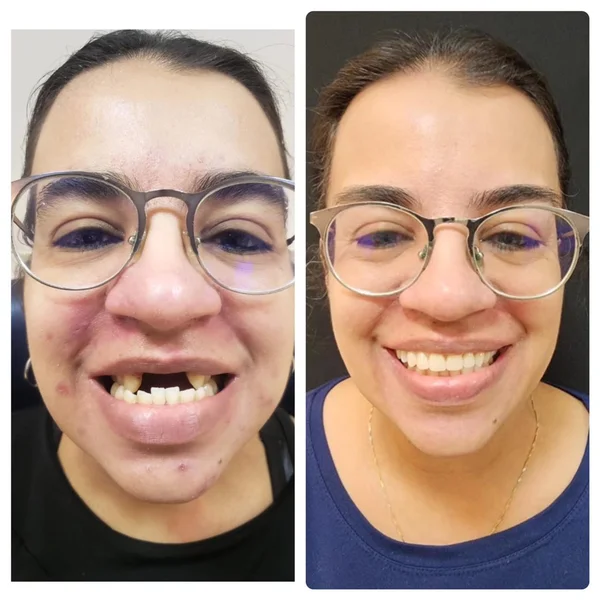 Fernanda, antes e depois do implante